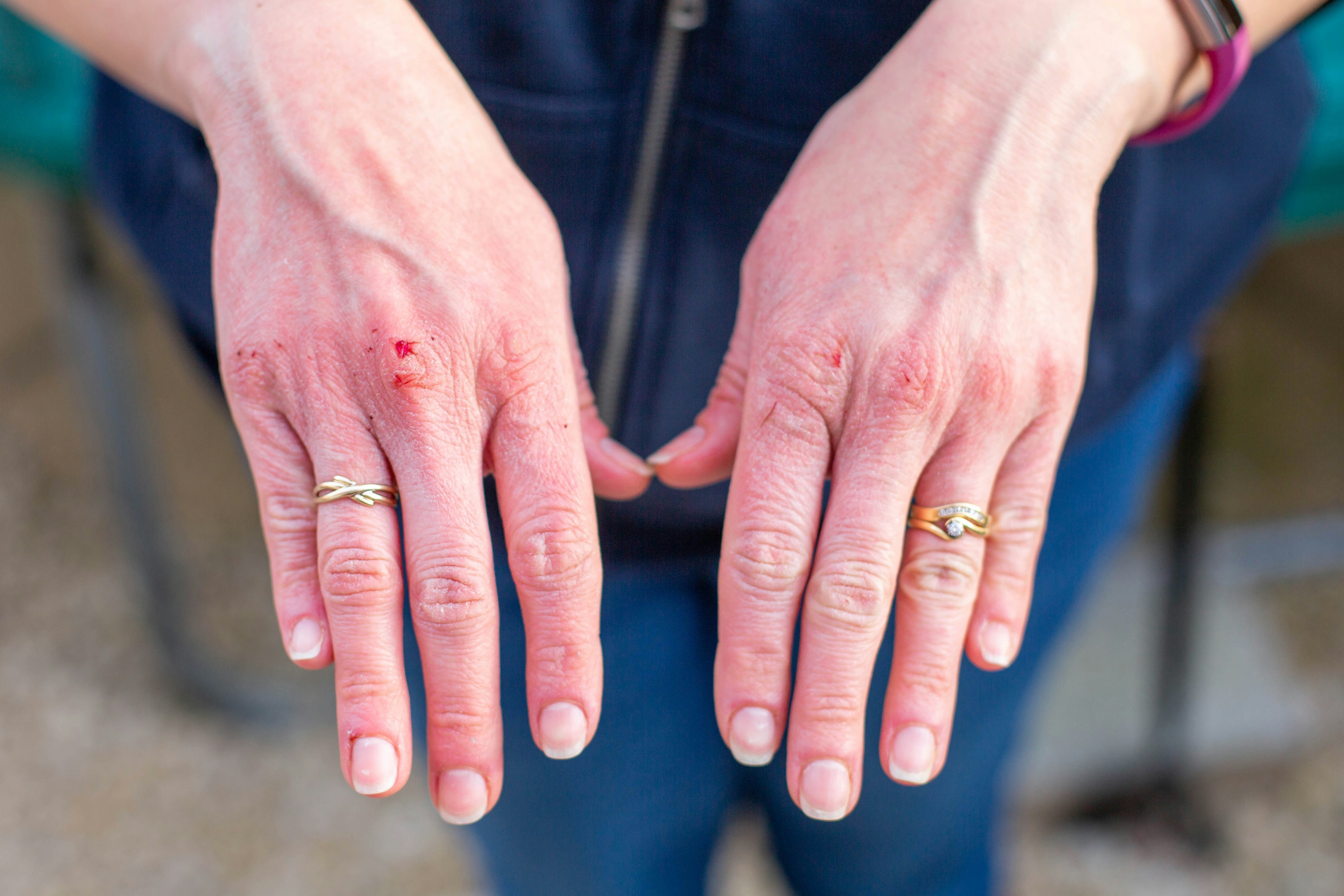 Stop Using Baby Wipes That Grip on Dry, Cracked Skin This Winter